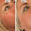 DermaCore Tratamento para Acrocórdons