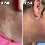 DermaCore Tratamento para Acrocórdons