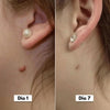 DermaCore Tratamento para Acrocórdons
