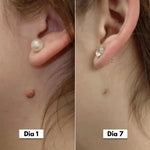 DermaCore Tratamento para Acrocórdons